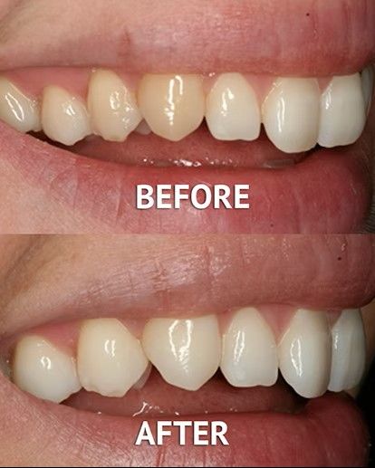 Whitening before and after