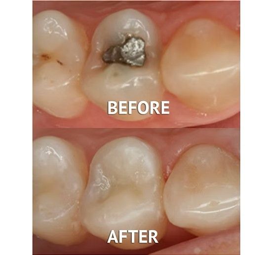 White filling replacement 