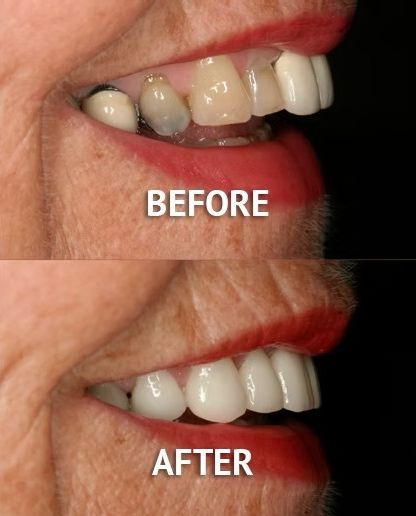 Veneers at Cleveland Terrace
